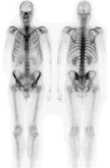 bone scan